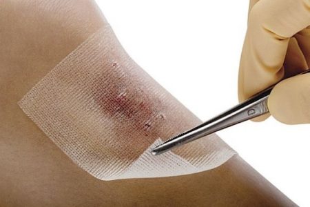 استفاده از روکش های پلیمری در درمان زخم های حساس