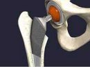 Sugar could help repair artificial joint implants