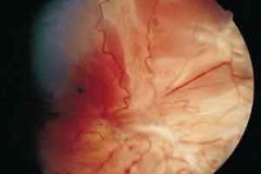 درمان بیماری‌های چشمی با کمک یک ترموژل منحصربه‌فرد